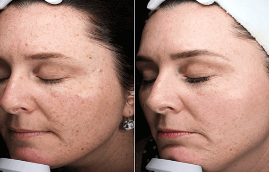 Pico Laser for Treating Acne